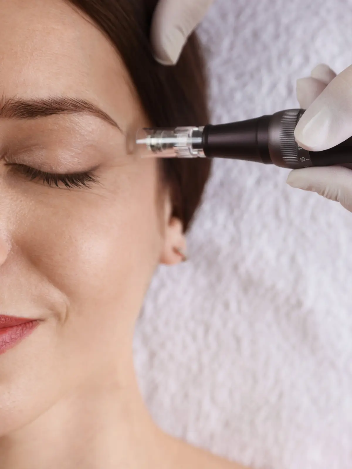 Microneedling London